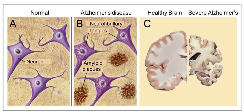 Gambar 1. Neurofibrillary tangles (NFT) dan Plak Amyloid pada Penderita Penyakit Alzheimer