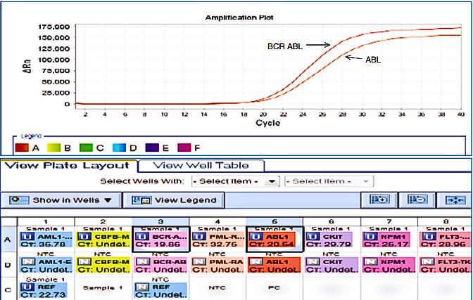 Gambar 1. Contoh AML positif BCR-ABL. Gambar menunjukkan lagi tata letak plate-well dan plot amplifikasi di AML (source: Bhargava, 2021. Springer).