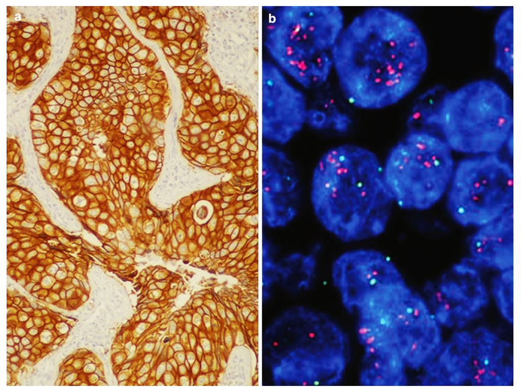 Gambar 1. IHC pada karsinoma duktal invasif untuk c-erbB-2 (a) dan amplifikasi onkogen HER-2/neu dengan hibridisasi fluoresensi in situ (b) [Mahdi Reza et al. 2021]