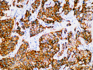 Gambar 1. IHC untuk spesimen kanker payudara dalam deteksi HER2 (syn: HER2 / neu, C-erbB2, erbB2) [Source: Elabscience]