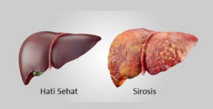 Gambar 1. Perbedaan Hati Sehat dan Hati Terkena SirosisSumber: https://www.medisata.com/penyakit/sirosis-hati