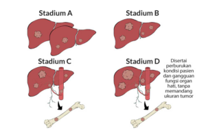 Gambar 3. Kanker Hati Stadium A, B, C dan DSumber: https://www.alodokter.com/kanker-hati