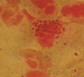 Gambar 6. Pewarnaan gram Neisseria gonorrhoeae pada pasien gonokokus genital