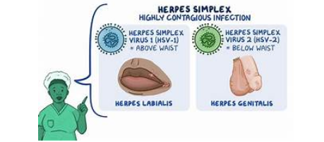 Gambar 8. Herpes Simplex Virus