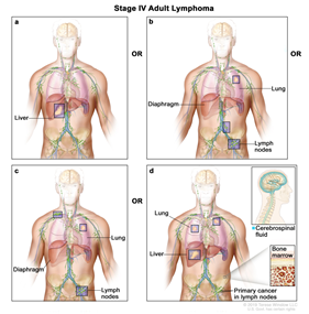(Stage IV adult lymphoma, https://www.ncbi.nlm.nih.gov/books/NBK65804/)