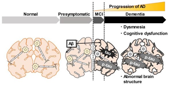 Gambar 1. Proses Perkembangan Penyakit Alzheimer