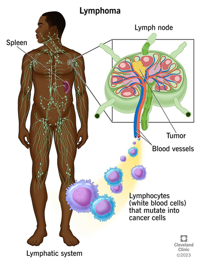 Gambar 1. Sistem Limfatik pada ManusiaSource: https://my.clevelandclinic.org/health/diseases/22225-lymphoma