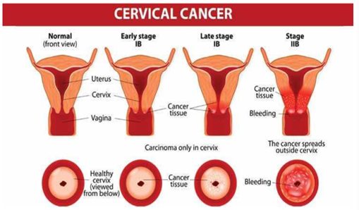 Gambar 1. Klasifikasi Kanker Serviks(Sumber: Azlina, 2025, hlm. 29)